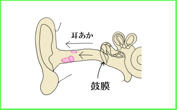 耳掃除の常識 補聴器専門店ミラックス 茅ヶ崎店